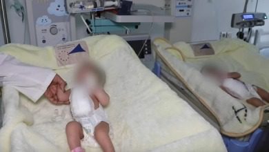 عملية جراحية لفصل توأم سيامي في مستشفى الاطفال ابن سينا بالرباط