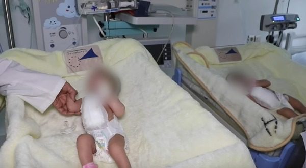 عملية جراحية لفصل توأم سيامي في مستشفى الاطفال ابن سينا بالرباط