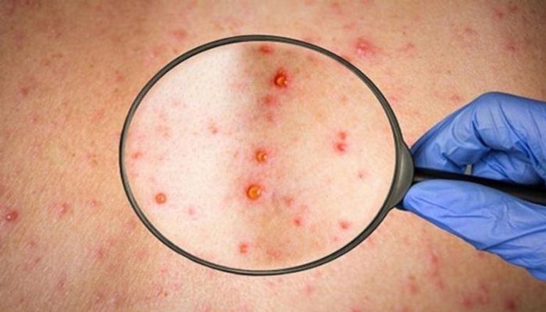 جدري القردة